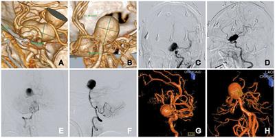 Flow-diverter stents combined with flow-T stenting-assisted coiling for the treatment of a large basilar apex aneurysm: a case report with a 9-month follow-up